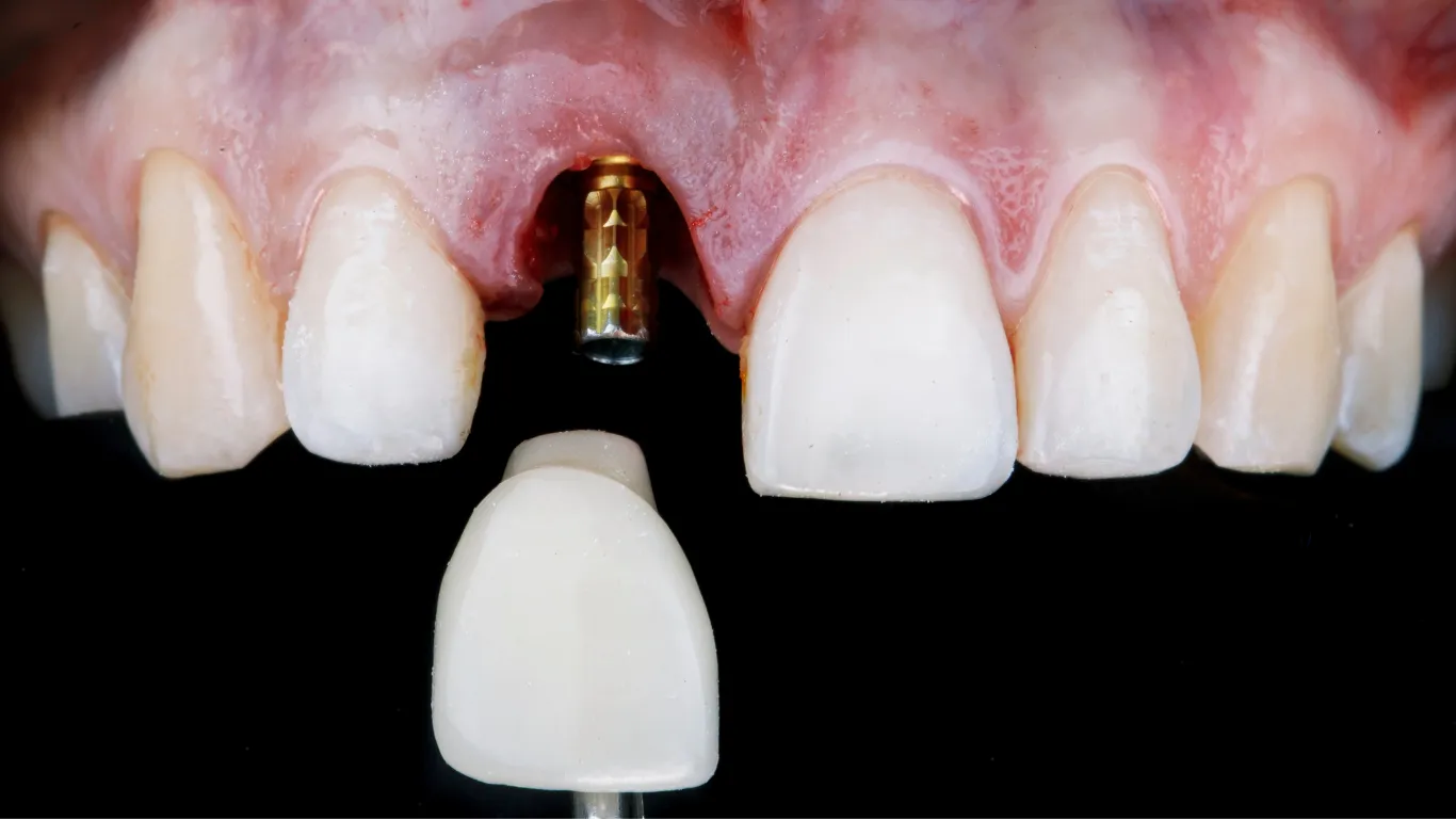 Implantaten